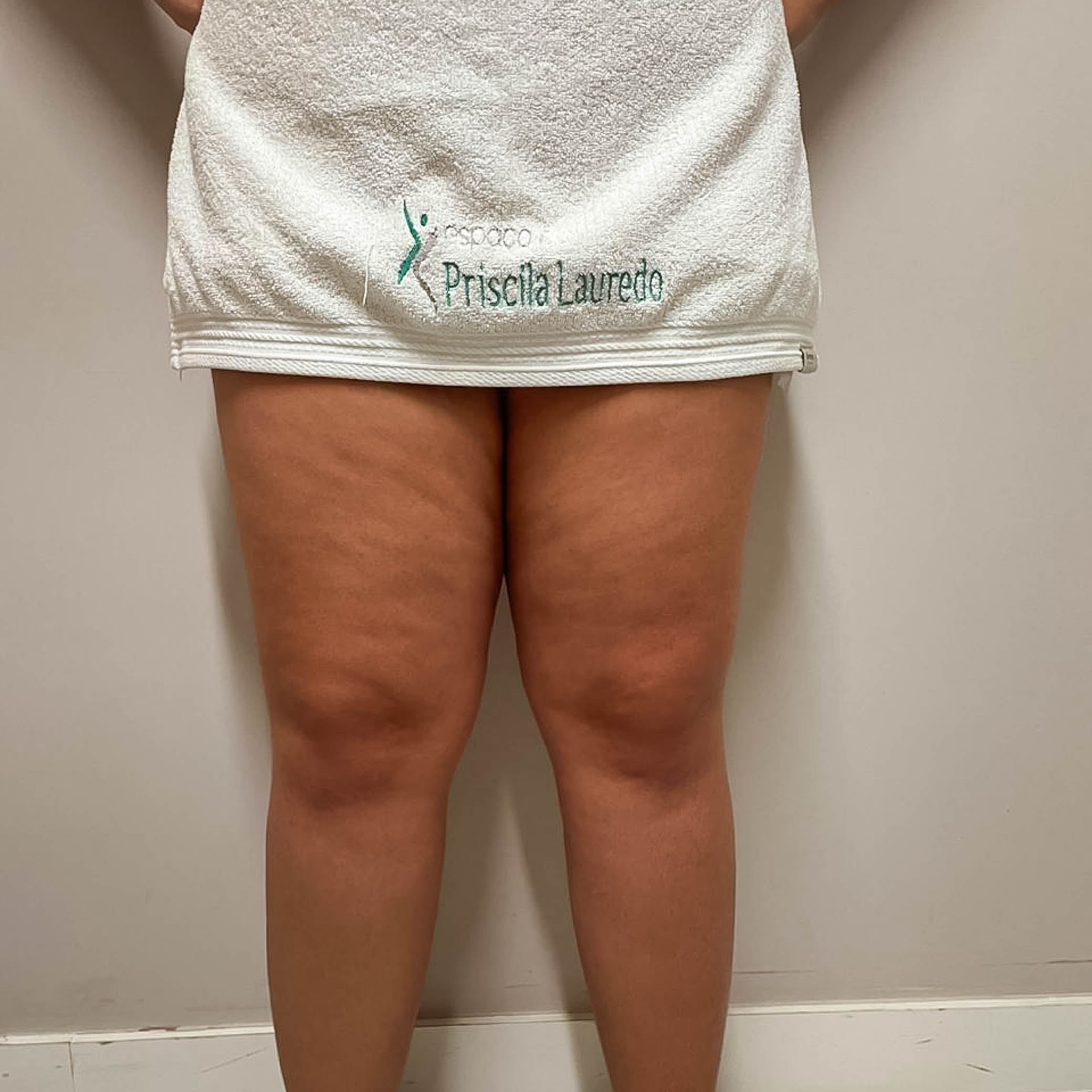 Lipedema
