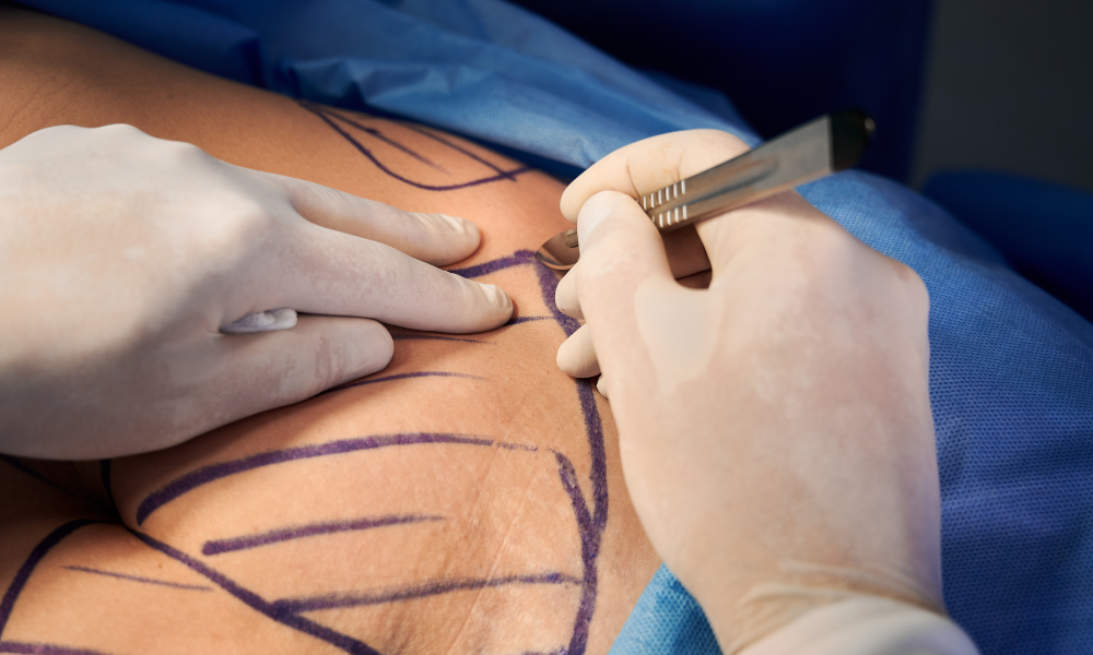 drenagem linfatica pos lipo