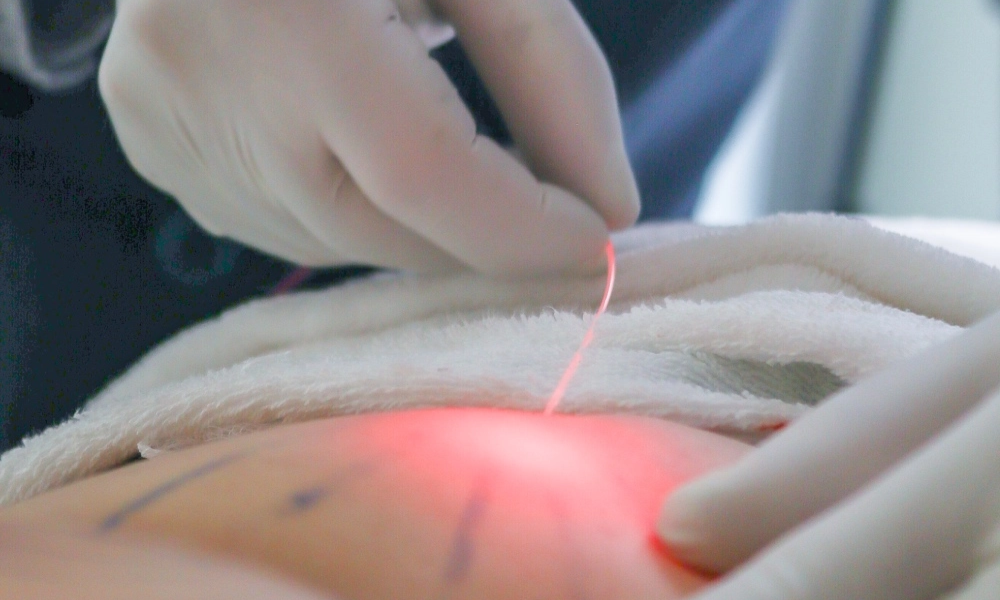 endolaser drenagem linfatica